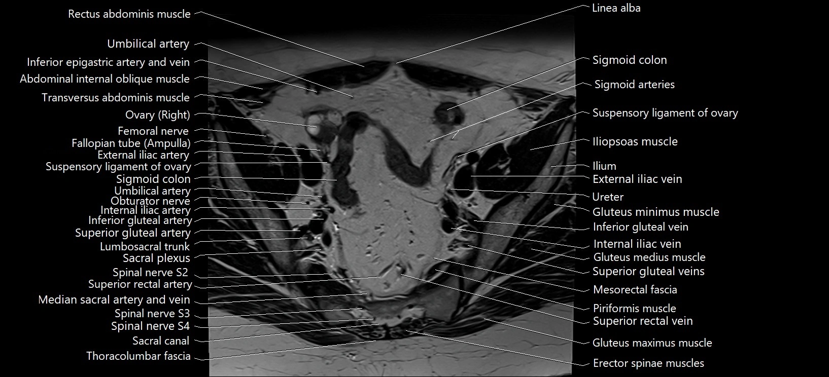 Axial cross sectional anatomy of female pelvis (MRI 3T) image 9.webp